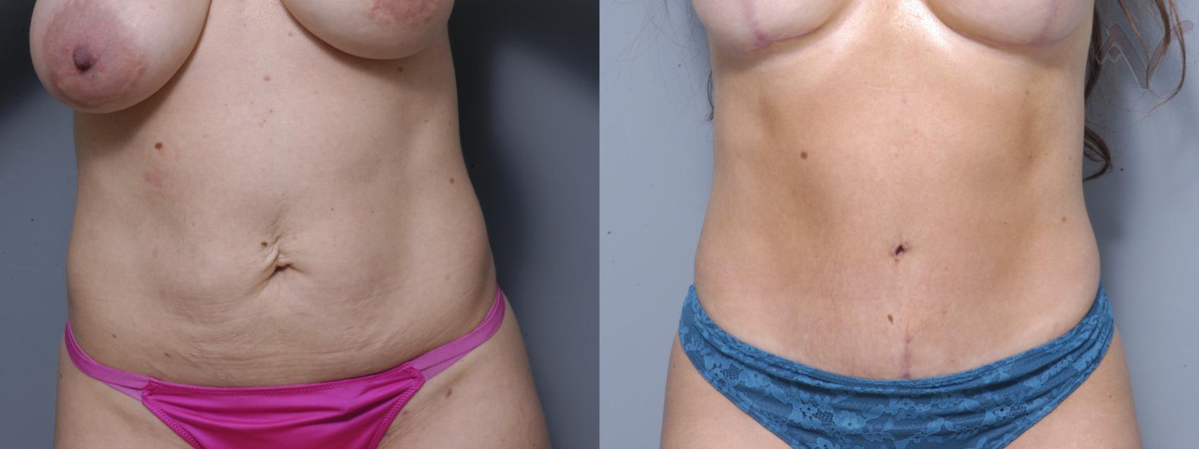 Before & After Tummy Tuck Case 274 Front View in Los Angeles, CA