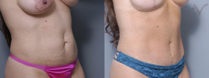 Before & After Tummy Tuck Case 274 Right Oblique View in Los Angeles, CA