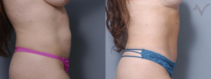 Before & After Tummy Tuck Case 274 Right Side View in Los Angeles, CA