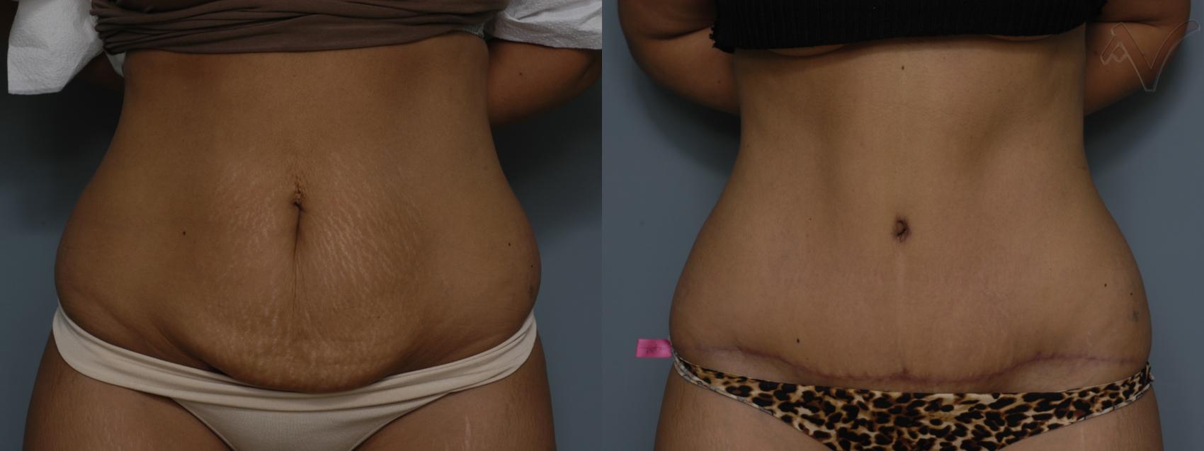 Before & After Tummy Tuck Case 279 Front View in Los Angeles, CA