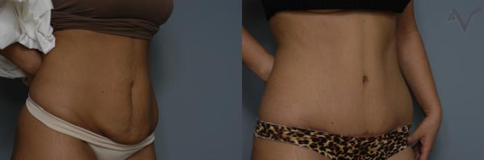 Before & After Tummy Tuck Case 279 Right Oblique View in Los Angeles, CA
