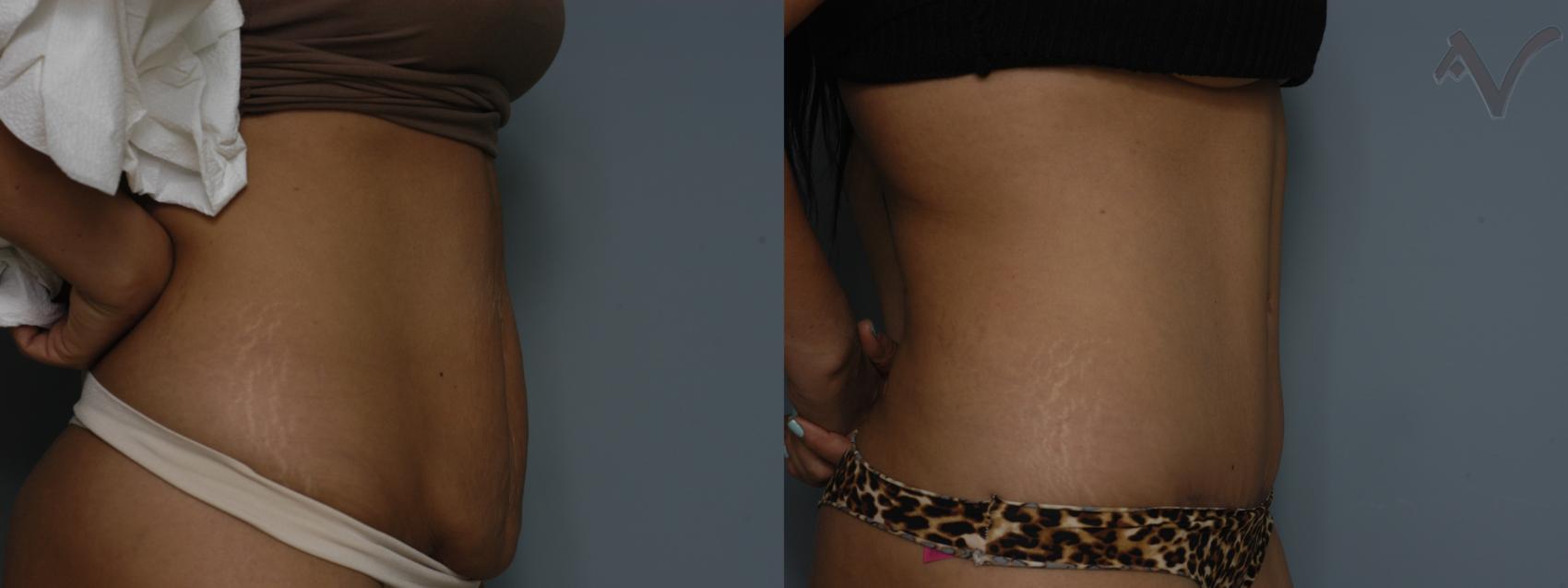 Before & After Tummy Tuck Case 279 Right Side View in Los Angeles, CA