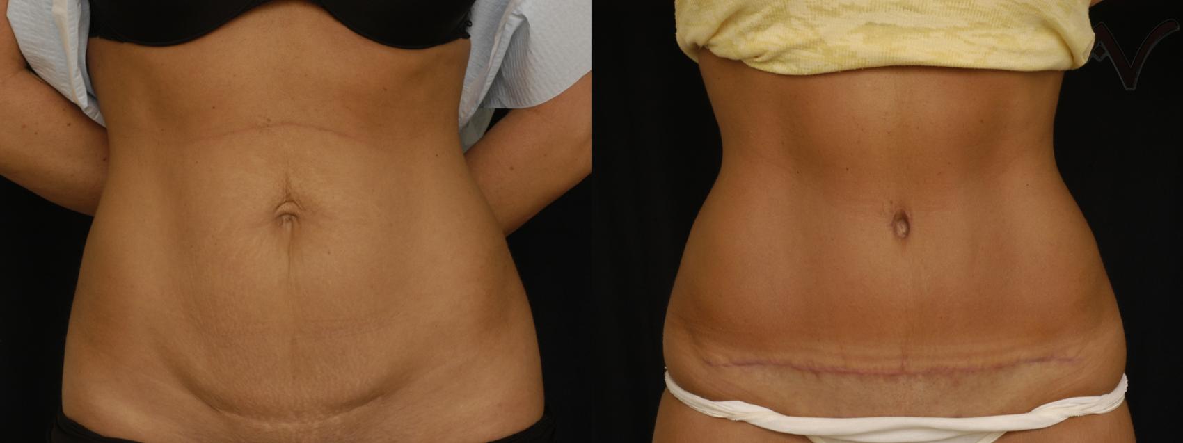 Before & After Tummy Tuck Case 280 Front View in Los Angeles, CA