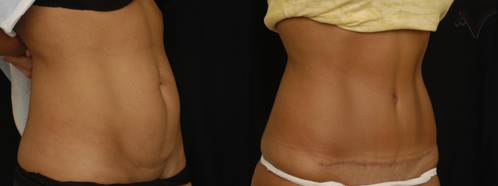 Before & After Tummy Tuck Case 280 Right Oblique View in Los Angeles, CA
