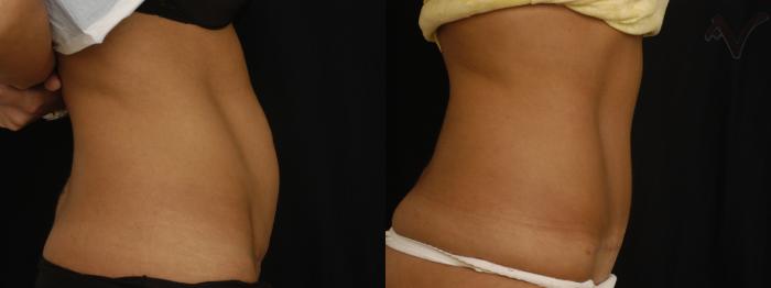 Before & After Tummy Tuck Case 280 Right Side View in Los Angeles, CA