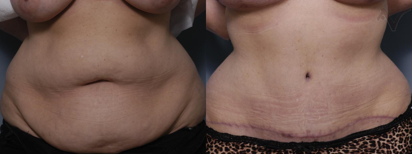 Before & After Tummy Tuck Case 281 Front View in Los Angeles, CA