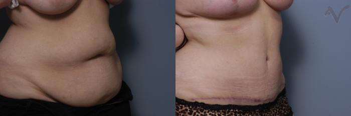 Before & After Tummy Tuck Case 281 Right Oblique View in Los Angeles, CA