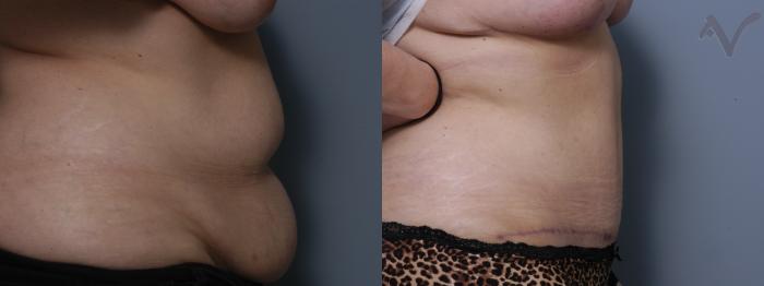 Before & After Tummy Tuck Case 281 Right Side View in Los Angeles, CA