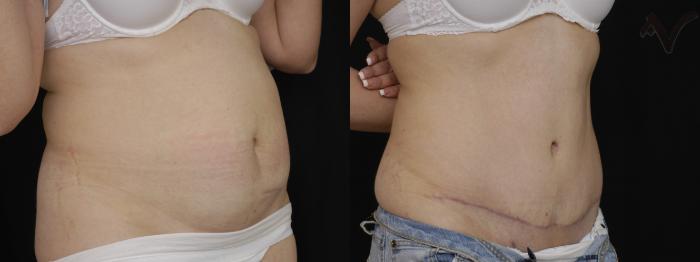 Before & After Tummy Tuck Case 282 Right Oblique View in Los Angeles, CA