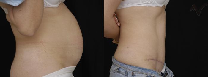 Before & After Tummy Tuck Case 282 Right Side View in Los Angeles, CA