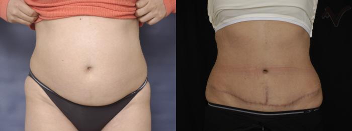 Before & After Tummy Tuck Case 283 Front View in Los Angeles, CA