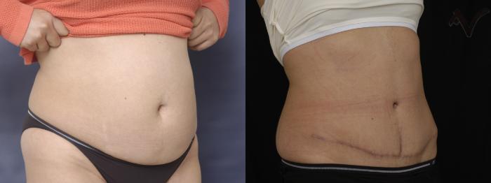 Before & After Tummy Tuck Case 283 Right Oblique View in Los Angeles, CA