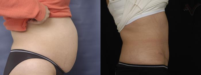 Before & After Tummy Tuck Case 283 Right Side View in Los Angeles, CA