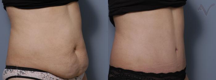 Before & After Tummy Tuck Case 284 Right Oblique View in Los Angeles, CA
