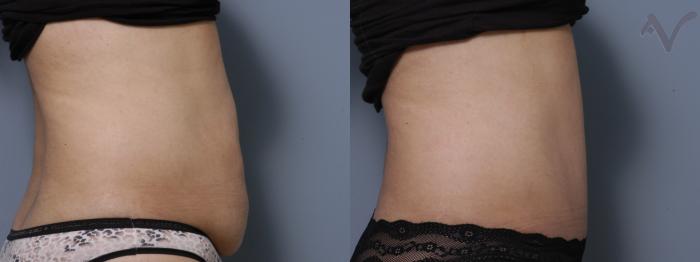 Before & After Tummy Tuck Case 284 Right Side View in Los Angeles, CA