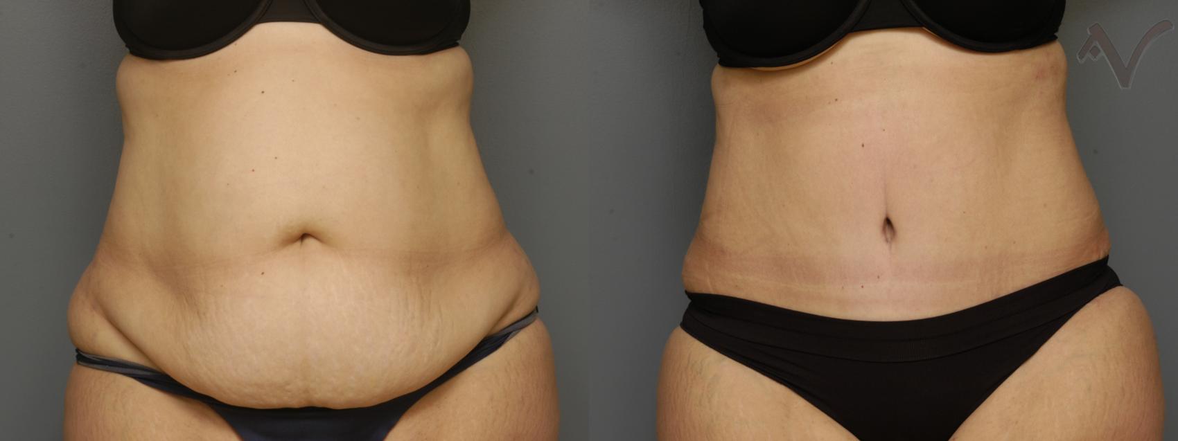 Before & After Tummy Tuck Case 346 Front View in Los Angeles, CA