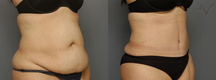 Before & After Tummy Tuck Case 346 Right Oblique View in Los Angeles, CA