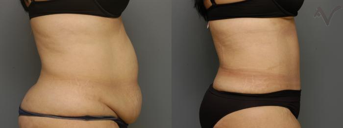 Before & After Tummy Tuck Case 346 Right Side View in Los Angeles, CA