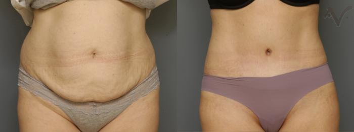 Before & After Tummy Tuck Case 354 Front View in Los Angeles, CA