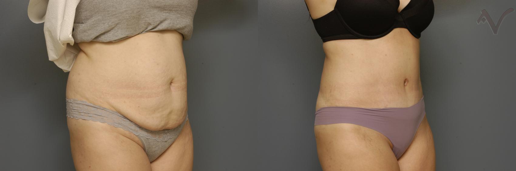 Before & After Tummy Tuck Case 354 Right Oblique View in Los Angeles, CA