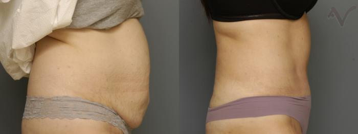 Before & After Tummy Tuck Case 354 Right Side View in Los Angeles, CA