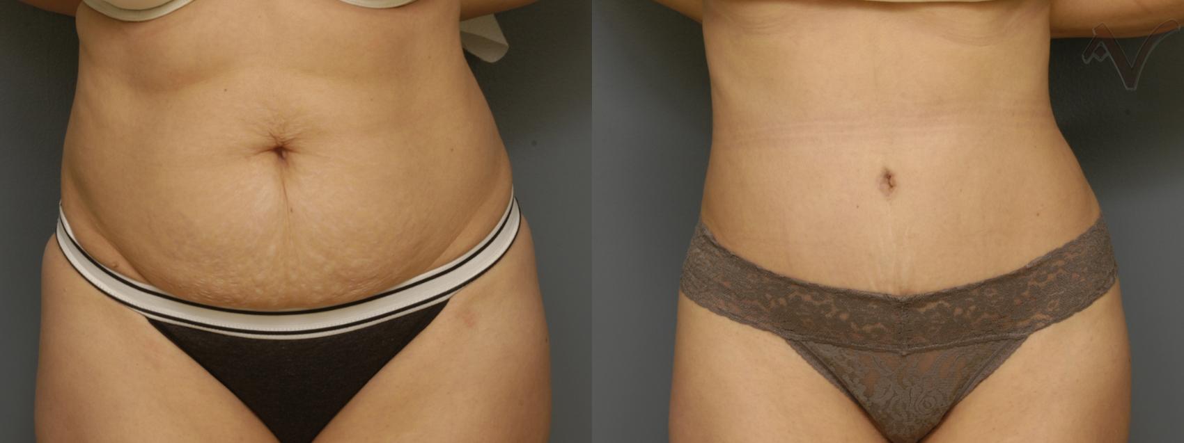 Before & After Tummy Tuck Case 355 Front View in Los Angeles, CA