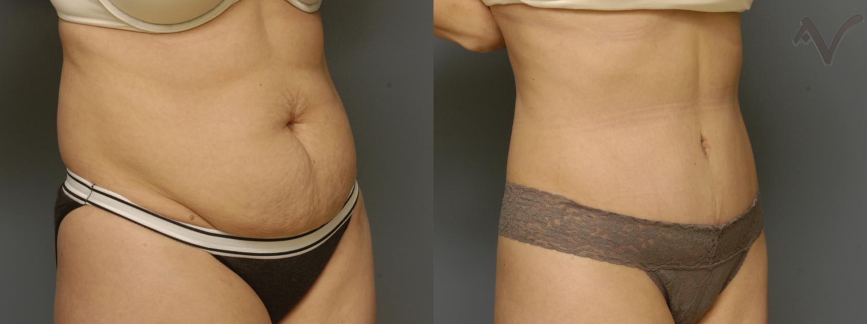 Before & After Tummy Tuck Case 355 Right Oblique View in Los Angeles, CA