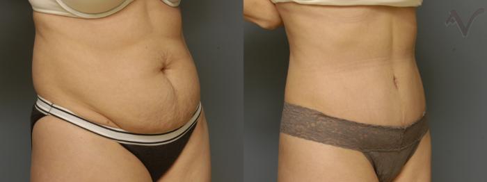 Before & After Tummy Tuck Case 355 Right Oblique View in Los Angeles, CA