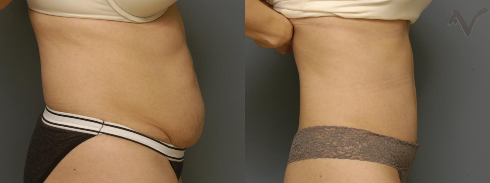Before & After Tummy Tuck Case 355 Right Side View in Los Angeles, CA