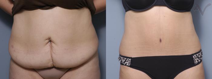 Before & After Tummy Tuck Case 362 Front View in Los Angeles, CA