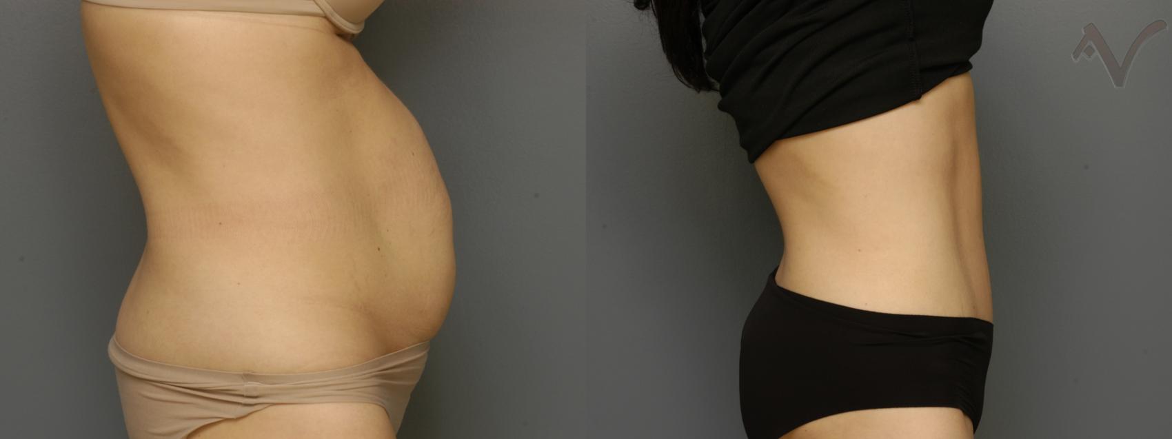 Before & After Tummy Tuck Case 363 Right Side View in Los Angeles, CA