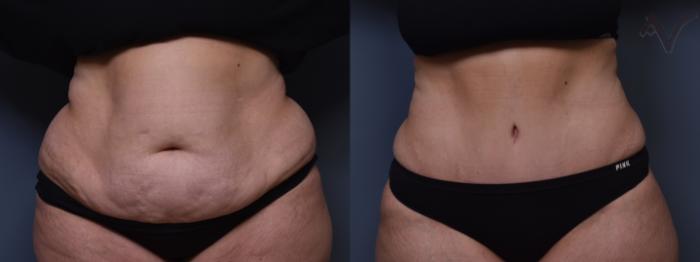 Before & After Tummy Tuck Case 385 Front View in Los Angeles, CA