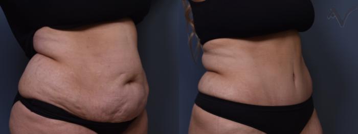 Before & After Tummy Tuck Case 385 Right Oblique View in Los Angeles, CA
