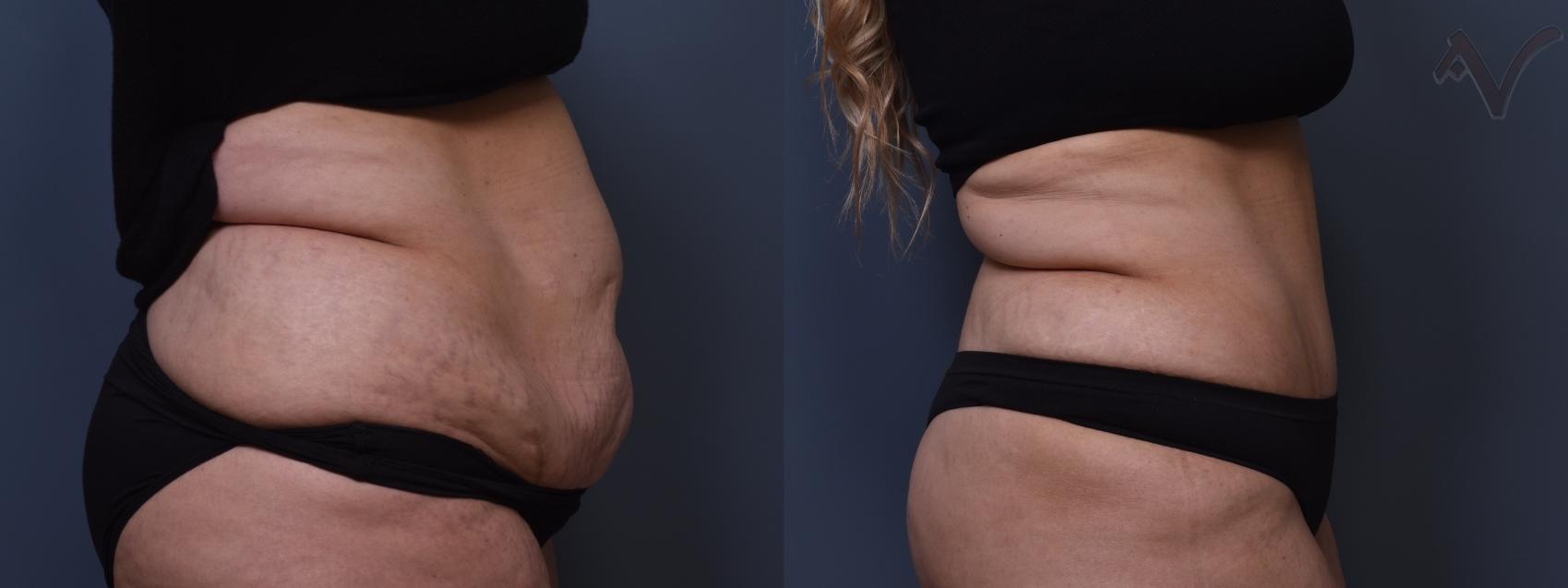 Before & After Tummy Tuck Case 385 Right Side View in Los Angeles, CA