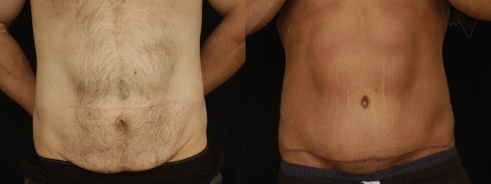 Before & After Tummy Tuck Case 394 Front View in Los Angeles, CA
