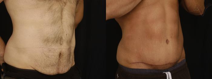 Before & After Tummy Tuck Case 394 Right Oblique View in Los Angeles, CA