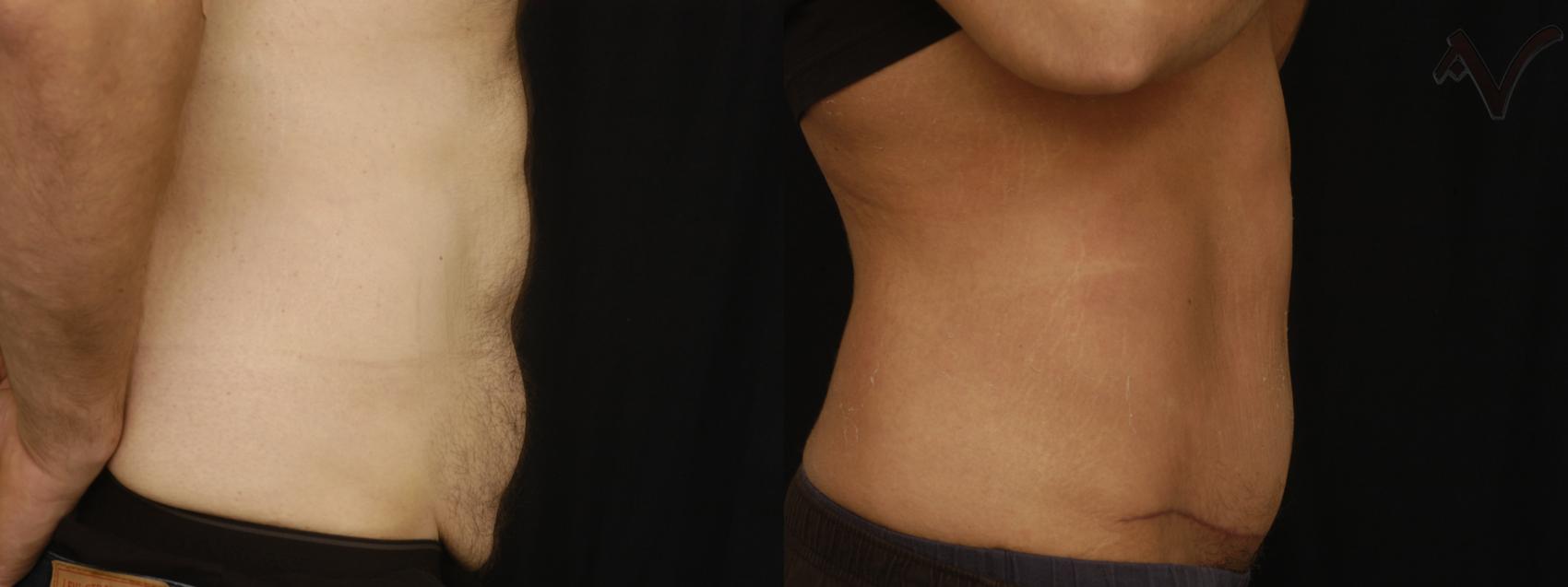 Before & After Tummy Tuck Case 394 Right Side View in Los Angeles, CA