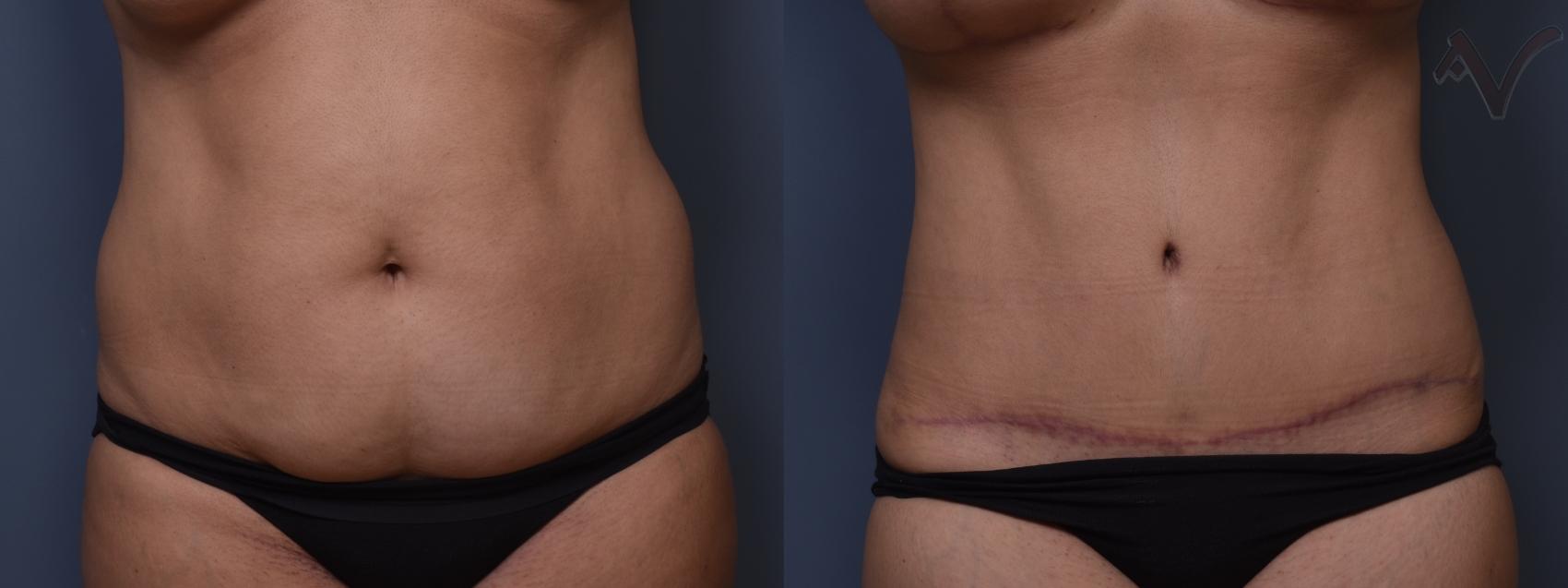 Before & After Tummy Tuck Case 397 Front View in Los Angeles, CA