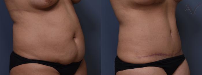 Before & After Tummy Tuck Case 397 Right Oblique View in Los Angeles, CA