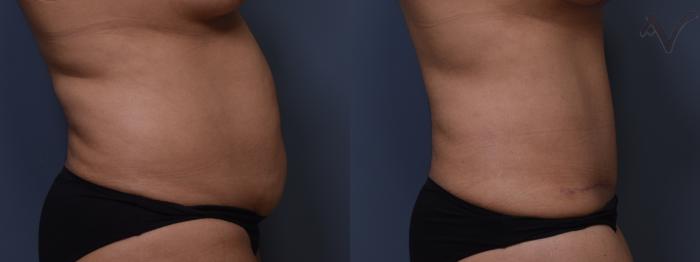 Before & After Tummy Tuck Case 397 Right Side View in Los Angeles, CA