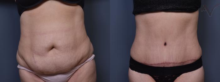 Before & After Tummy Tuck Case 399 Front View in Los Angeles, CA