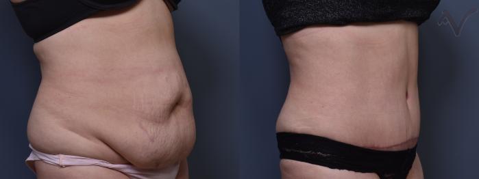 Before & After Tummy Tuck Case 399 Right Oblique View in Los Angeles, CA