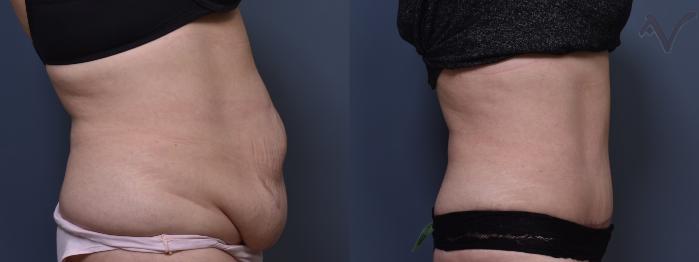 Before & After Tummy Tuck Case 399 Right Side View in Los Angeles, CA