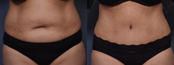 Before & After Tummy Tuck Case 405 Front View in Los Angeles, CA