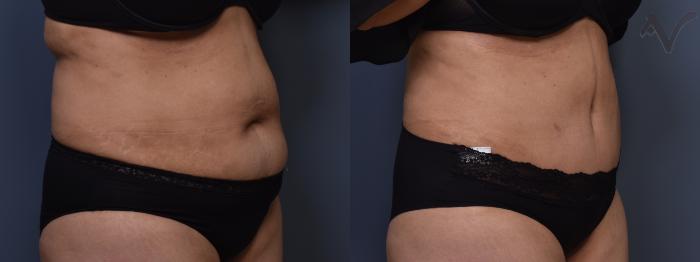 Before & After Tummy Tuck Case 405 Right Oblique View in Los Angeles, CA