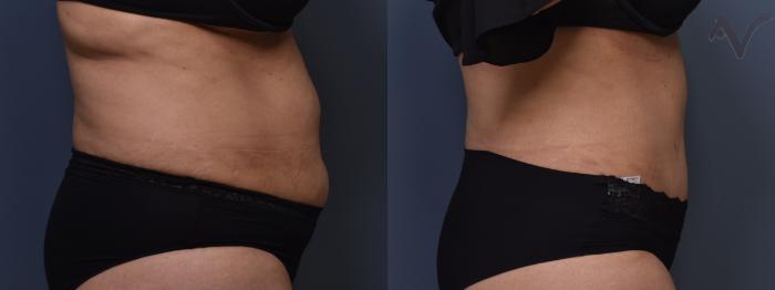 Before & After Tummy Tuck Case 405 Right Side View in Los Angeles, CA