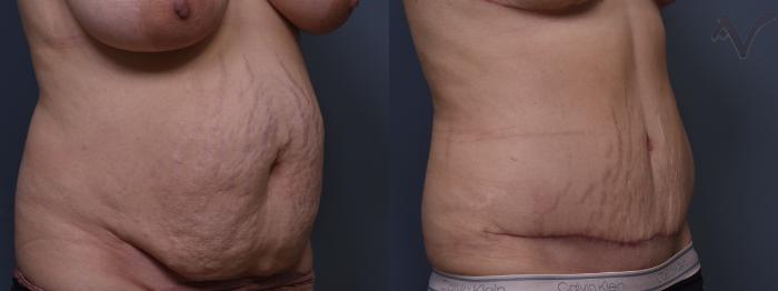 Before & After Tummy Tuck Case 419 Right Oblique View in Los Angeles, CA