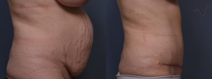 Before & After Tummy Tuck Case 419 Right Side View in Los Angeles, CA