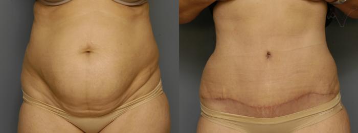 Before & After Tummy Tuck Case 462 Front View in Los Angeles, CA