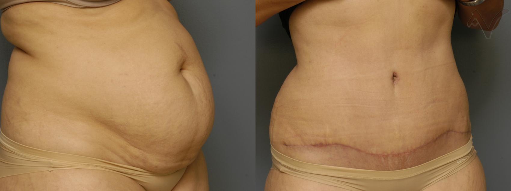 Before & After Tummy Tuck Case 462 Right Oblique View in Los Angeles, CA